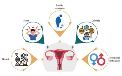 Polycystic Ovary Syndrome (PCOS) Diet Plan Weight Loss